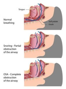 Types of Sleep Apnea