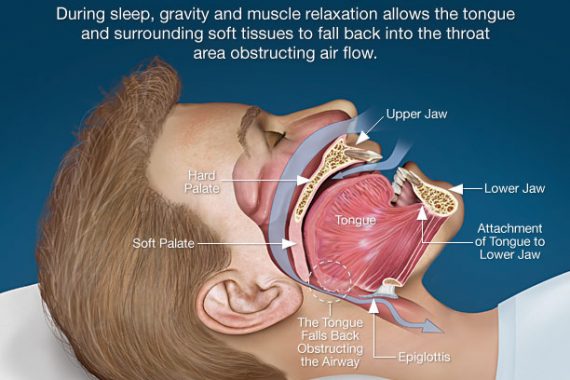 obstructive-sleep-apnea