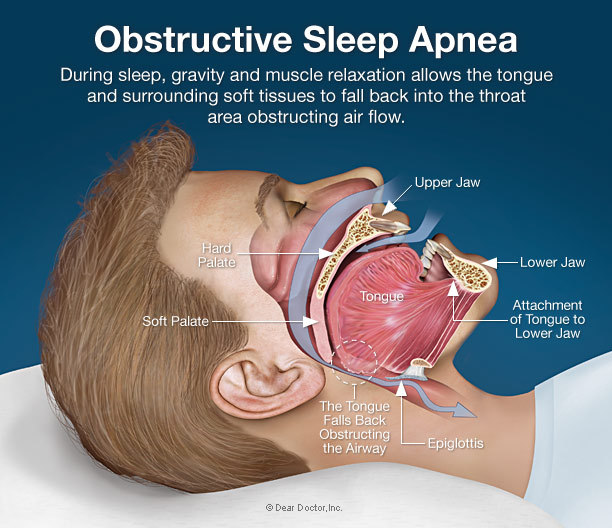 Obstructive Sleep Apnea Asonor